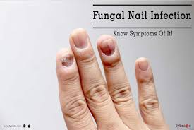 fungal nail infection know symptoms