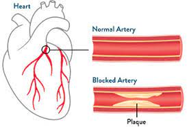 coronary artery disease abbott