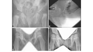 A D Radiographic Evidence Charting The Acetabular Dysplasia