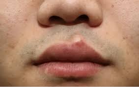 epidermal cyst on upper lip