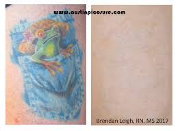 Tattoo removal is more effective for individuals with lighter skin (specifically fitzpatrick type 1 or 2 skin types). Before After Photos Austinpicosure Com A Tattoo Removal Nurse S Notes