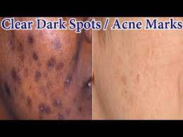 home remedy to get rid of dark spots
