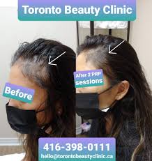 toronto hair loss treatment with prp