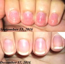 Why do my nails still feel sore to the touch four days after having my acrylic nails removed? If You Have Brittle Nails You Need To Try These 12 Products You Can Get On Amazon