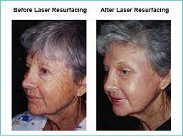 co2 laser resurfacing austin tx