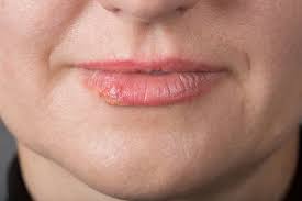 canker sore images
