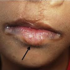 lip pits in van der woude syndrome