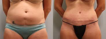 tummy tuck before afters omaha dr