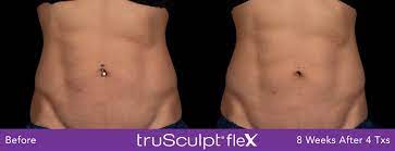how much is trusculpt id body sculpting