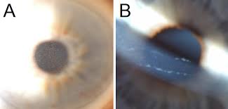 If symptomatic, the following treatments may be recommended Corneal Dystrophy Article