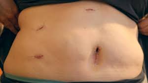 gallbladder surgery scars healing and