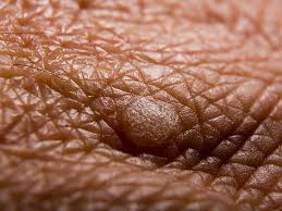 types of warts pictures symptoms and