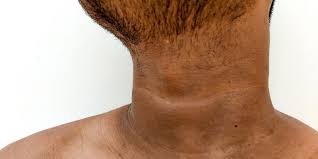 dark neck symptoms causes treatment