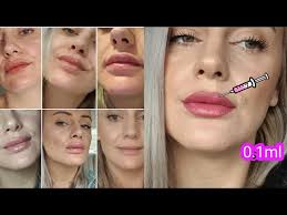 lip fillers my experience healing