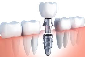 common questions about dental implants
