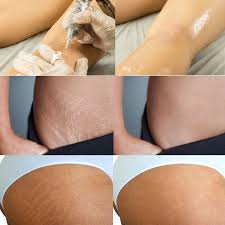scar camouflage for stretch marks