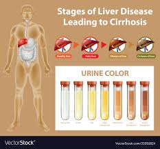 ses liver disease leading to