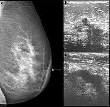 Paget's disease of the breast. Spectrum Of Imaging Findings In Paget S Disease Of The Breast A Pictorial Review Insights Into Imaging Full Text