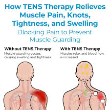 using tens therapy for muscle pain