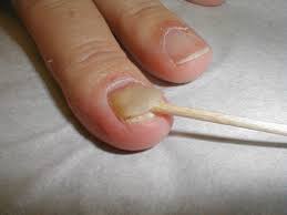 onycholysis separation of nail from