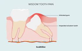 treat swollen gums near wisdom tooth