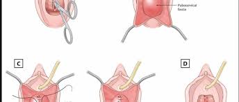 anterior inal wall repair csf surgery