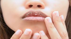 chapped lips using home remes