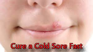 get rid of a cold sore fast hubpages