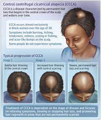 topical metformin for alopecia