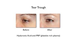 I used a microcannula technique. Filler Treatments For Under Eye Bags Tear Troughs And Slight Eye Bags