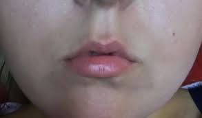 is it possible to get wider lips when