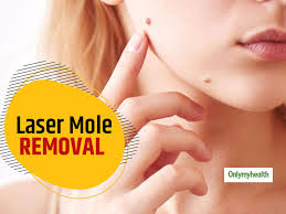laser mole removal
