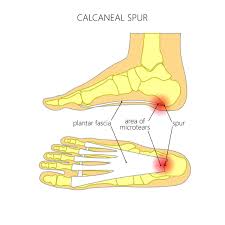 The appearance of julia, a young charismatic and emancipated english girl, in her neighbourhood turns diane's everyday life upside down. Bone Spur Treatment Symptoms And Prevention Preferred Foot Ankle