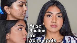for acne e skin acne pigmentation