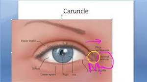 ophthalmology 068 d eye caruncle what