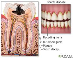 dental cavities medlineplus cal