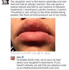 an allergic reaction to lip balm