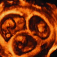 As soon as the woman discovers she is pregnant, she should make an appointment with the gynaecologist for a first ultrasound. 3d Ultrasound Of Triplets At 8th Week Of Gestation 3 Embryos In Three Download Scientific Diagram