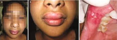 lip oro granulomatosis