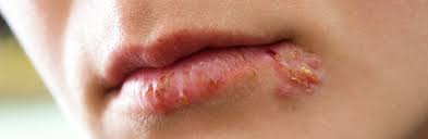 Kunden die zu lippenbläschen (herpes simplex) neigen, können wenige tage nach der behandlung herpes am/um den mund bekommen. Mooci Herpes Unangenehm Juckende Blasen Auf Der Haut