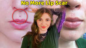 my lip piercing scar removal cost