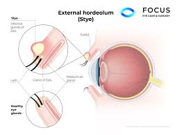 stye focus eyecare and surgery