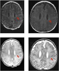 We did not find results for: The Brain S Kryptonite Overview Of Punctate White Matter Lesions In Neonates Sciencedirect