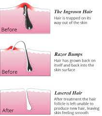best ingrown hair treatment laser