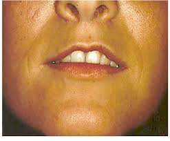 thin upper lip after ineffective