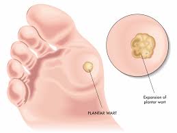 Pictures and videos about cysts and pimples. Warts Harvard Health