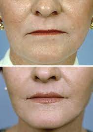 corner of mouth lift post facelift