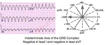 Determine Axis On A 12 Lead Ecg Tracing Learntheheart Com