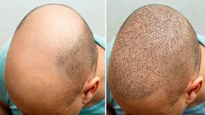 hair transplant cost in india hair