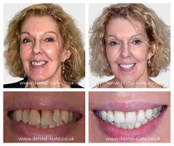 We did not find results for: Dental Implant Treatment In Leicester Loughborough For Missing Teeth